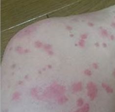 バラ疹 梅毒の皮膚症状
